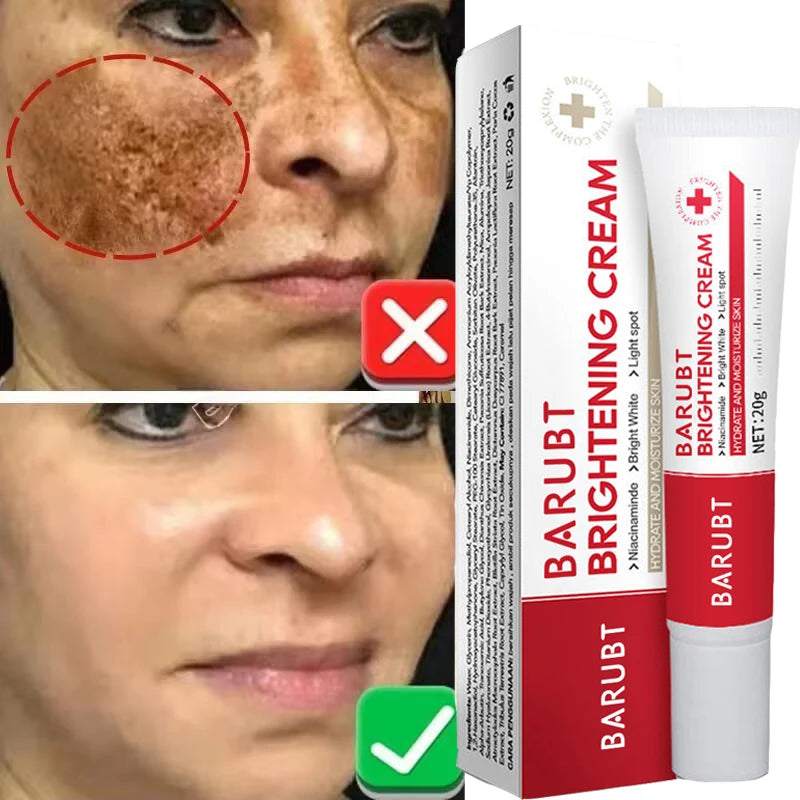 Powerful Whitening Freckles Face Cream Brighten Skin Removal Melasma Dark Spots Fade Stain Melanin Moisturizing Beauty Care Gel