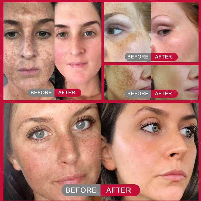 Whitening and anti-freckle cream removes dark spots, chloasma, freckles, age spots, lightens pigmentation, removes facial spots