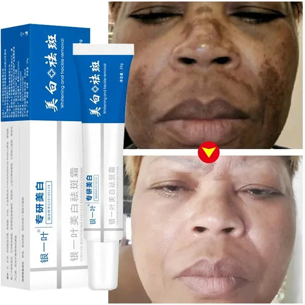 Whitening Blemish Cream Effectively Removes Melasma Dark Spots Fade Melanin Moisturize Brighten Smooth Beauty Face Skin Care